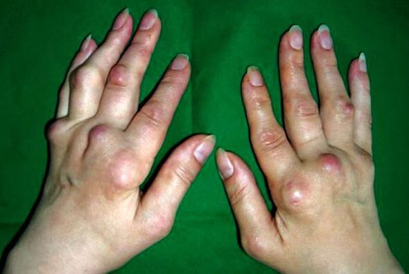Руки, пораженные деформирующим полиостеоартрозом